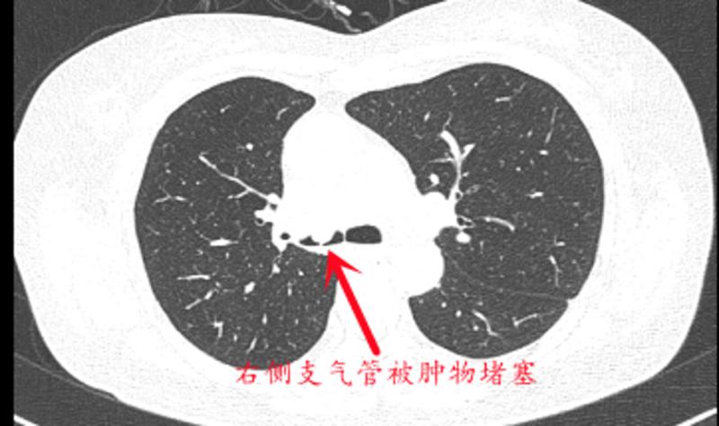 肺癌患者反复咳血 南山医院新技术“烧死”罪魁祸首