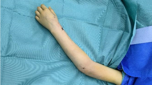 9岁女童不慎摔伤骨折 医生8mm微创接骨