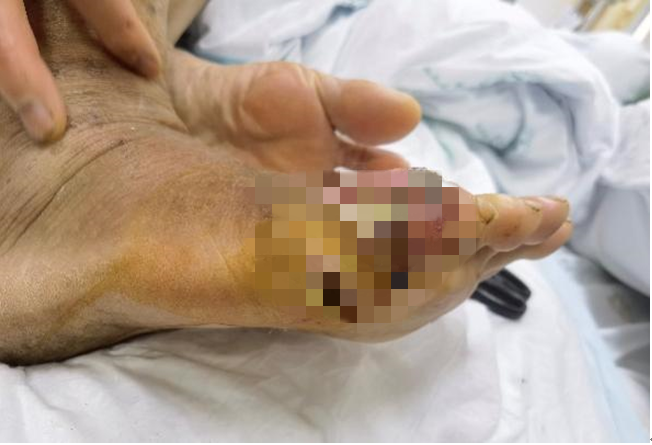 脚底小伤口一年未愈烂到穿洞 医生：糖尿病人群要注意
