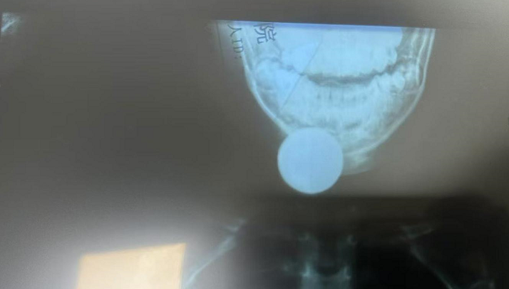 幼儿硬币卡喉辗转就医 龙岗铁骑一路护送