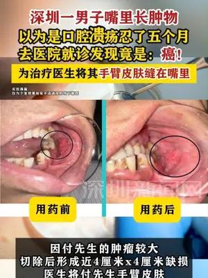 深圳男子以为是口腔溃疡五个月一查竟是癌
