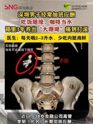 男子肾结石不重视3年养成大珊瑚