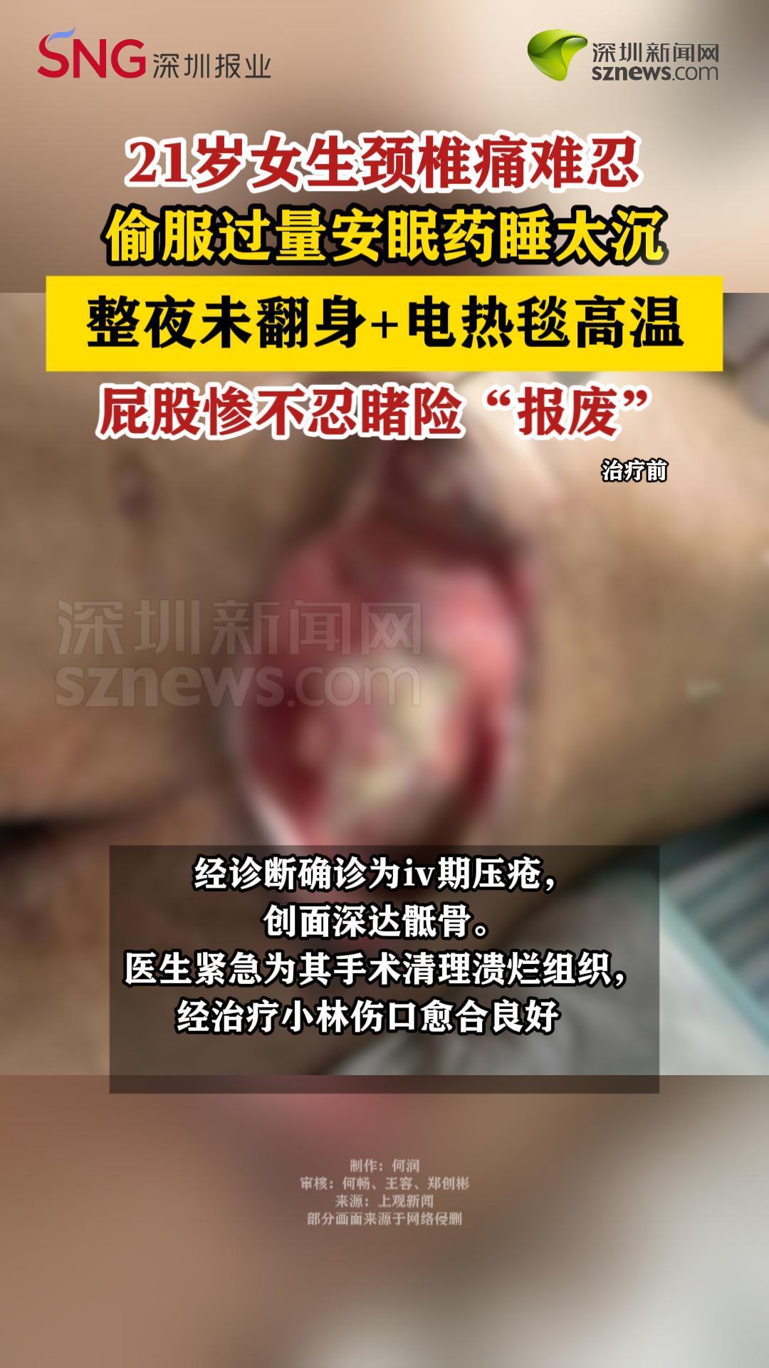 21岁女生夜里睡太沉没翻身，醒来屁股惨不忍睹险“报废”