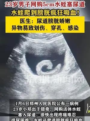 男子塞5cm水蛭进尿道爬到膀胱吸血不止