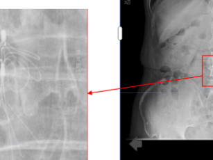七旬老人血管救命网变“拦路虎” 深圳医生“抄近道”手术助其心安