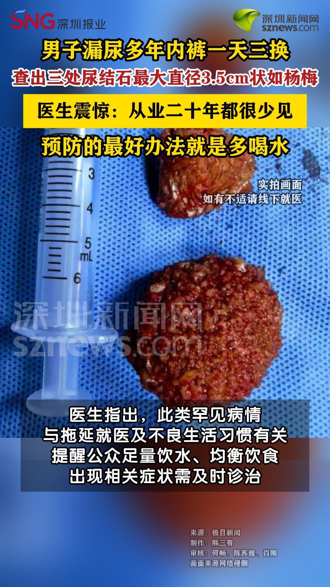 男子漏尿多年查出三处大结石震惊医生