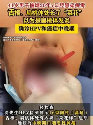 41岁男子嘴里长“菜花”确诊HPV和癌症中晚期