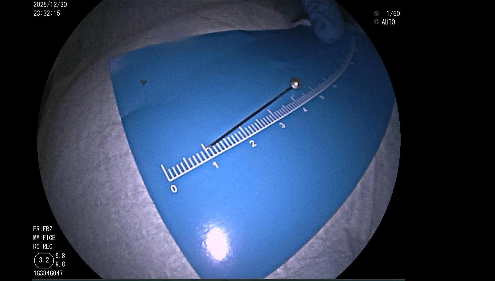 男孩误吞玩具大头针 深圳医生30分钟“大海捞针”