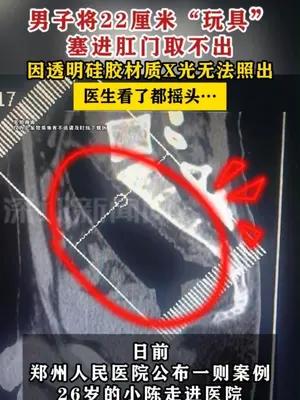 男子将22厘米“玩具”塞进肛门取不出