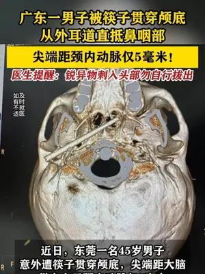 广东一男子被筷子贯穿颅底 尖端距颈内动脉仅5毫米