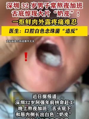 深圳32岁男子长期熬夜加班舌头长出大片“奶皮”