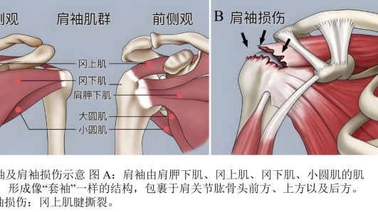 深圳二院龙华医院首例微创肩袖修补术 57岁患者1小时重获肩功能