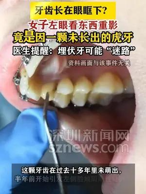 女子看东西重影竟是因为一颗虎牙