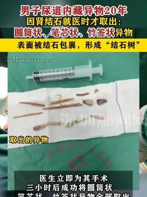 男子尿道内藏异物20年，因肾结石就医时才取出圆筒状等异物
