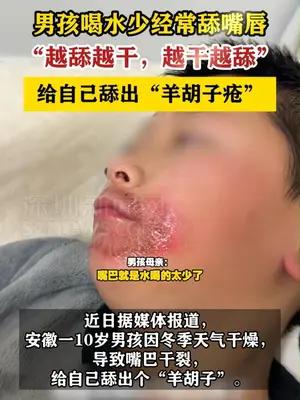 男孩经常舔嘴唇舔出“羊胡子疮”