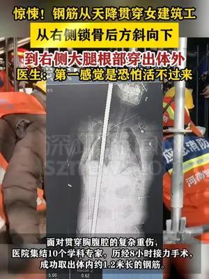 惊悚！钢筋从天降贯穿女建筑工 医生：第一感觉是恐怕活不过来