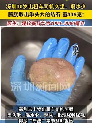 久坐、喝水少，深圳30岁出租车司机膀胱里长出拳头大的结石