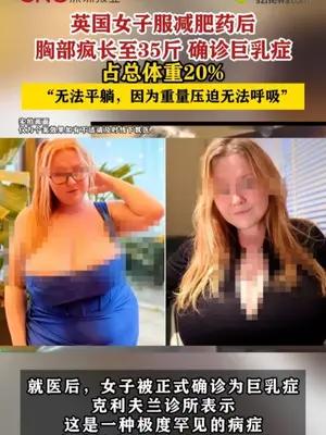 英国女子服减肥药后胸部疯长至35斤确诊巨乳症