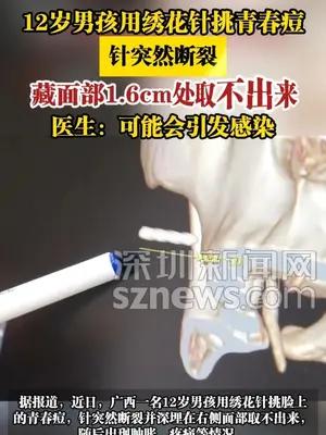 12岁男孩用绣花针挑青春痘针突然断裂 取不出来