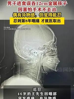 男子进食误吞12cm金属筷子忍了8年才取出