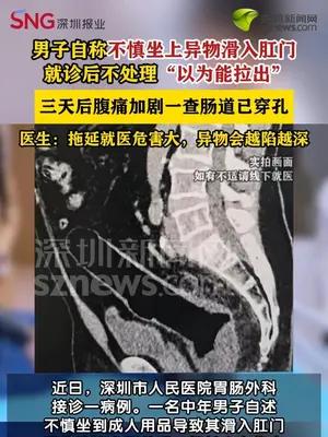 男子自称不慎坐上异物滑入肛门，忍三天后肠道穿孔被迫造口
