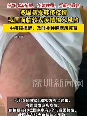 我国面临较大麻疹疫情输入风险