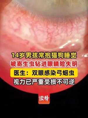 14岁男孩与猫狗同吃同睡，双眼感染弓蛔虫险失明，医生：不可逆