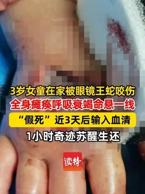 云南3岁女童被眼镜王蛇咬伤，“假死”3天后奇迹生还