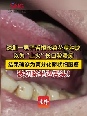 深圳41岁男子舌根长“菜花”以为“上火”结果是癌
