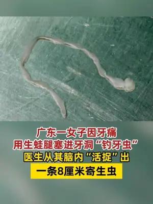 女子用生蛙腿“钓牙虫”，医生从其脑内“活捉”出寄生虫