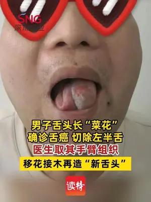 男子舌头长“菜花”患舌癌，医生取手臂组织再造“新舌头”
