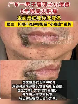 广东一男子唇部长小痘痘8年拖成大肿瘤
