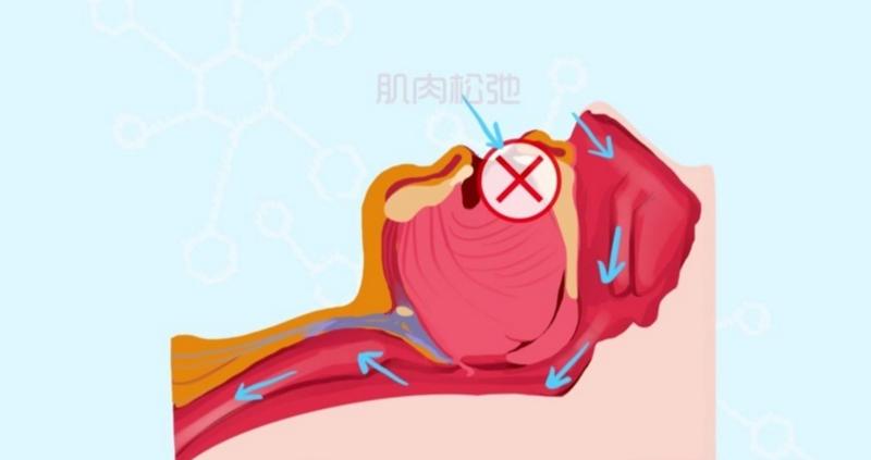 【健康通】医生解答：“打鼾”究竟是怎么回事