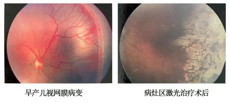 早产儿眼底视网膜病变治疗前后对比.
