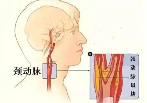 頸動脈是人體通向頭面部的主要動脈,正常時它供給腦組織85%的血液.