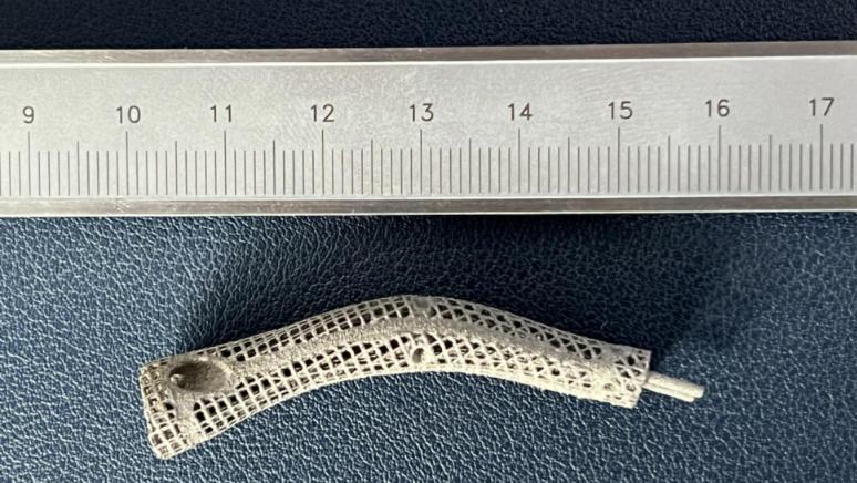 深圳27岁男子手指骨缺损植入3D打印钛合金假体