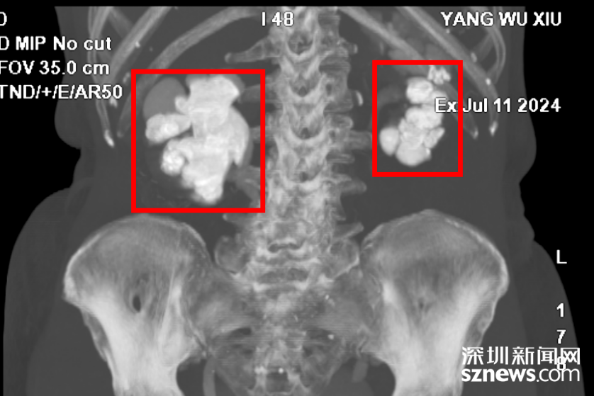 老人肾结石比鸡蛋大！专家0.5厘米单通道“挖矿”