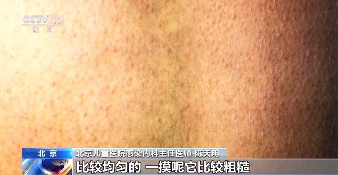 孩子发热、咽痛还伴皮疹,“小红人”到底是种什么病?_深圳新闻网