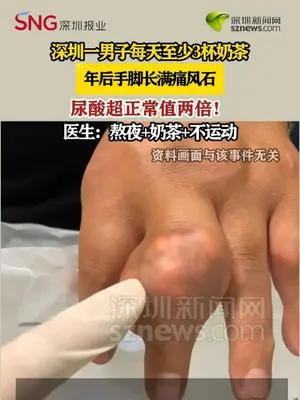深圳男子每天3杯奶茶 6年后双手双脚长满“痛风石”