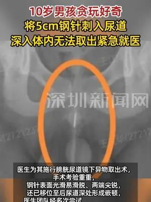 10岁男孩将5cm钢针刺入尿道