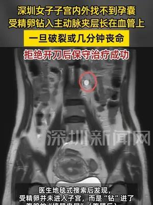 深圳女子受精卵钻入主动脉夹层