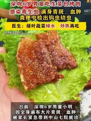深圳6岁男童吃生菜包烤肉感染寄生虫 医生：绿叶蔬菜焯水、炒熟再吃