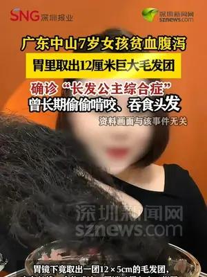 广东7岁女孩贫血腹泻，胃里取出12厘米巨大毛发团