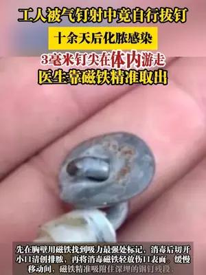 工人被气钉射中竟自行拔钉，3毫米钉尖在体内游走，医生靠磁铁精准取出