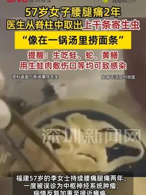 57岁女子脊柱中取出千条寄生虫 医生形容“像在一锅汤里捞面