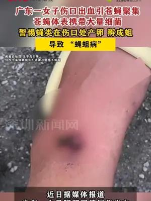 广东一女子伤口出血引苍蝇聚集