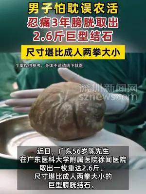 男子怕耽误农活，忍痛3年膀胱取出2.6斤巨型结石