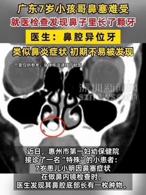 广东7岁小孩哥鼻子里长了颗牙