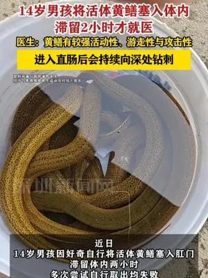 14岁男孩腹痛就医取出活黄鳝