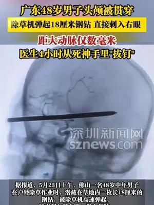 广东48岁男子头颅被贯穿，除草机弹起钢钻刺入右眼